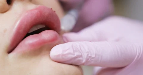 Close up view of Patient’s Lips during the Lip Augmentation. Beautician’s Stock Footage 91257783