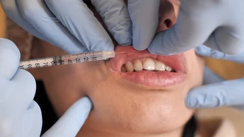 Close-up view of Patient’s Lips during the Lip Augmentation. Beautician’s Stock Footage 123292770