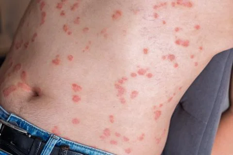 Close-up view of a person's back showing psoriasis skin condition with red .. Foto stock