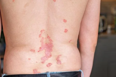 Close-up view of a person's back showing psoriasis patches on skin, with a Foto stock