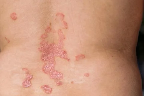 Close-up view of psoriasis patches on the back of a person, showcasing red,.. Foto stock