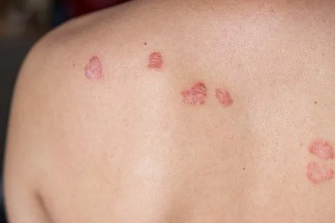 Close-up view of psoriasis patches on the back of a person, highlighting sk.. Foto stock