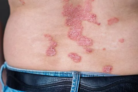 Close-up view of psoriasis patches on the lower back of a person wearing blue Foto stock