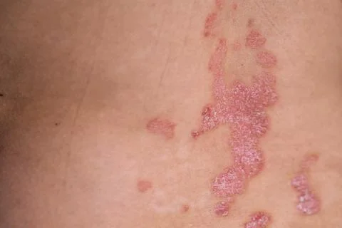 Close-up view of psoriasis skin condition showing red patches and scales on.. Foto stock