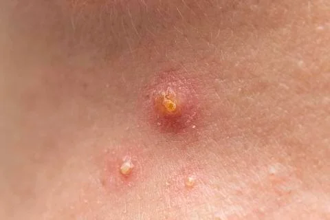 A close up view of pus filled spots on caucasian skin, clustered together, si 스톡 사진