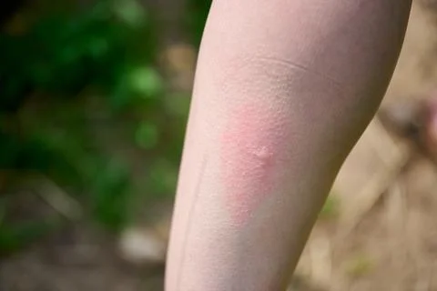 Close-up view of red mosquito bite on human skin Stock Photos