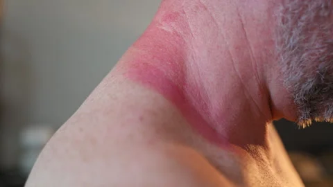 Close up view of red sunburned skin on the neck of an older adult after Stock Footage 340156212