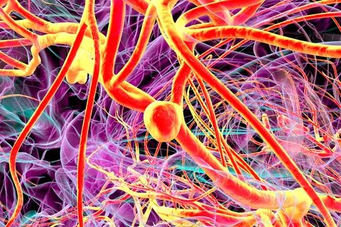 A close-up view of a saccular aneurysm on a brain artery, 3D illustration Stock Illustration