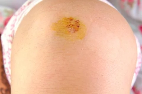 Close up view on a scraped knee Stock Photos