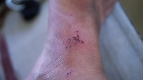 Close up view of a scratch mark and red skin irritation on a human ankle. Stock Footage 345973300