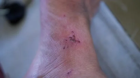 Close up view of a scratch mark and red skin irritation on a human ankle. Stock Footage 345973352