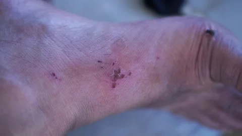 Close up view of a scratch mark and red skin irritation on a human ankle. Stock Footage 345973391