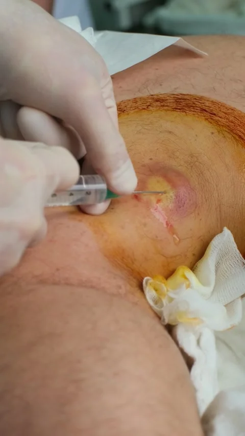 Close-up view of a surgeon performing a medical procedure, using a syringe to Stockbeeldmateriaal 337723361