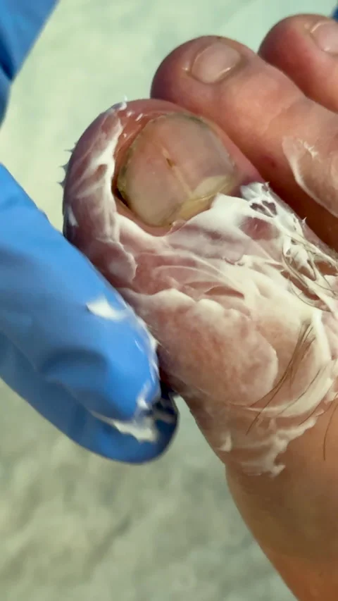 Close-up view of a swollen toe with visible hematoma being treated with cream by Vídeos de archivo 335524479