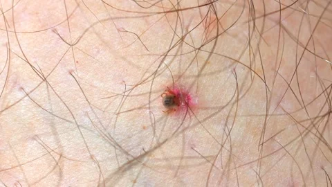 Close-up view of tick biting human skin, potentially causing Lyme 動画素材 271476360