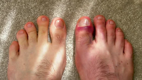 Close-up view of two human feet on a light carpet, one foot with a bruised big 스톡 동영상 333653089