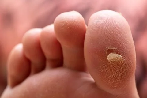 A close up view on the underside of a big toe (hallux) of a Caucasian person. 스톡 사진