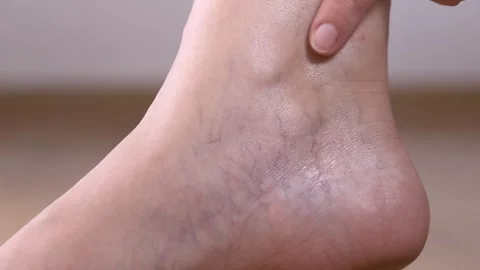 Close-up view of visible leg veins and mild telangiectasia on adult skin Stock Footage 321816746