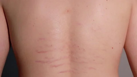 Close up view of young pearson's back with striae distensae (striae rubrae) Stock Footage 148069927