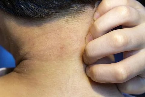 A close up view of a young person's neck showing skin irritation and being Stock Photos
