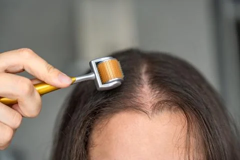 Close up view of young woman using microneedle derma roller on head for Stock Photos