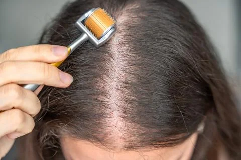 Close up view of young woman using microneedle derma roller on head for Stock Photos