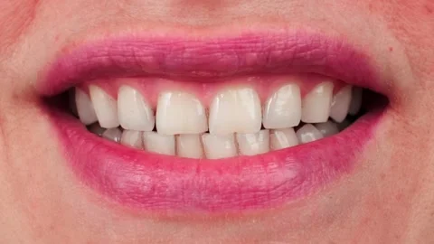 Close-up of white teeth with particles of black calculus. Dental care problems Stock Footage 278547374