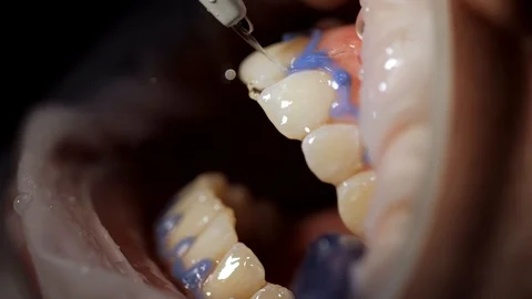 Close-up whitening of woman's teeth Stock Footage 113703702