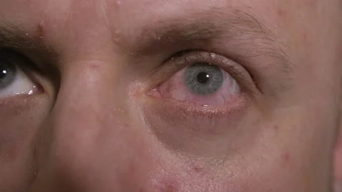 Close-up of wide open red and irritated human eye. Allergy. Stock Footage 125440065