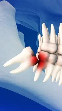Close-up of wisdom teeth pain concept Illustrazione stock
