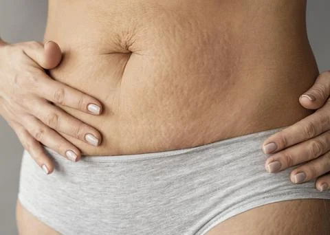 Close up woman with stretch marks Beautiful photo Stock Photos