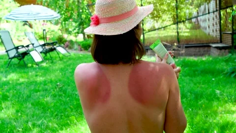 Close up of a woman's back with uneven pigmentation. woman applying sunscreen Stock Footage 202482927