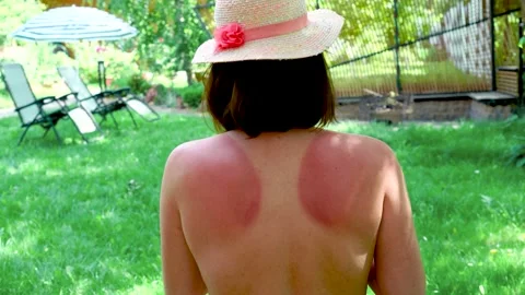 Close up of a woman's back with uneven pigmentation. woman applying sunscreen. Stock Footage 219006841