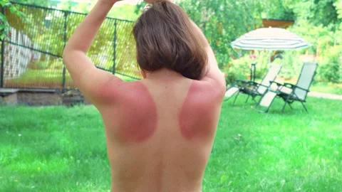 Close up of a woman's back with uneven pigmentation. woman applying sunscreen Stock Footage 234785347
