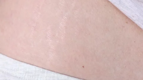 Close-up of a woman's body with scars and stretch marks after Stock Footage 180905824