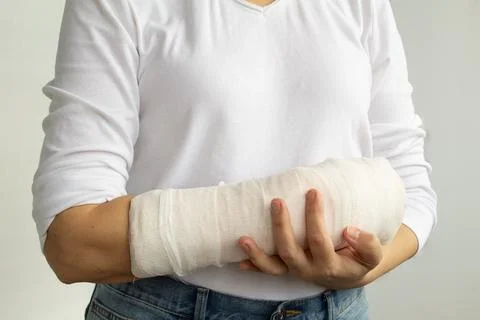 Close-up of a woman's broken arm in a plaster cast. Stock Photos