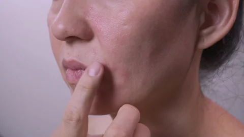 Close-up of a woman's face. Skin texture with a problem on the skin The girl Stock Footage 155758305