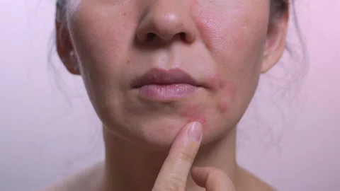 Close-up of a woman's face. Skin texture with a problem on the skin The girl Stock Footage 155759463