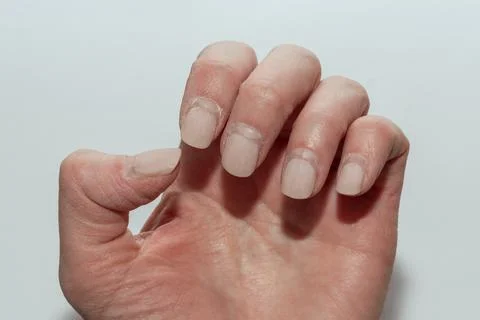 A close-up of a woman's hand with a broken artificial nail on the thumb, sh.. Stock Photos