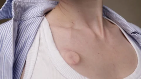 Close-up of a woman's hand touching an implanted chest port, capturing self.. Stock Footage 338237182