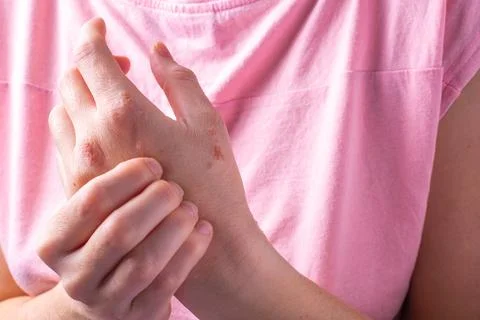 Close-up of a woman's hands itching. dermatitis or eczema on the hands. Stock Photos