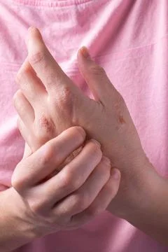 Close-up of a woman's hands itching. dermatitis or eczema on the hands. Stock Photos