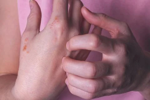 Close-up of a woman's hands strongly itching. Stock Photos