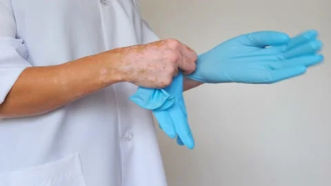 Close-up of a woman's hands with vitiligo spots. A doctor in a white coat wears 스톡 동영상 158982215
