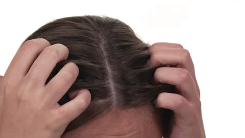 Close up on a woman's head scratching intensively her scalp, showing unpleasant Stock Footage 197440979