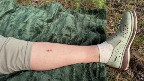 Close-up of a woman's leg with red mosquito bites on a picnic blanket  Vidéo 338035836