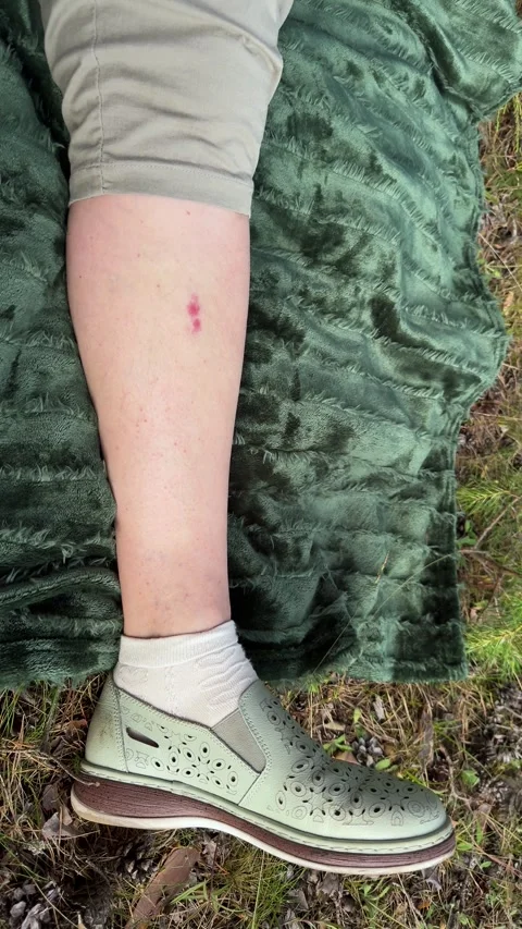 Close up of woman's leg with red mosquito bites on picnic blanket  库存影片 338035963