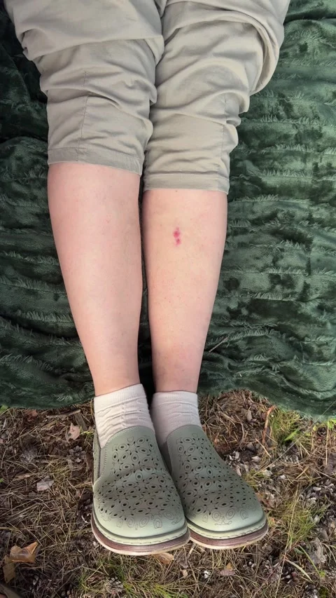 Close-up of woman's legs with red insect bites on picnic blanket in summer  Video stock 338035969