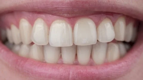 Close-up of a woman's smile before and after teeth whitening. Stock Footage 165116342