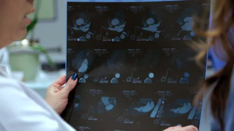 Close-up X-ray in Doctor's Hands. Hospital. Team Of Doctors Working on Diagnosis Stock Footage 164634401